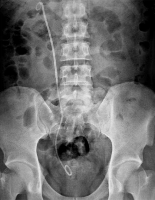 KUB revealing implanted double J stent in appropriate p | Open-i