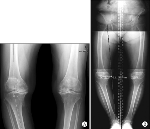 A Anteroposterior Standing Radiograph Of Both Knees S Open I 4721