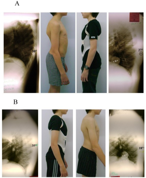 In-brace correction in two subsequent braces of one pat