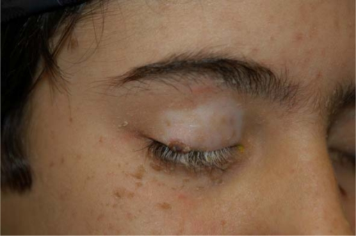 Previous poliosis and vitiligo of the right eyelids. Mu | Open-i