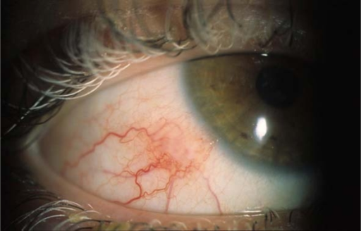 Conjunctival inflammatory nodule in the inferotemporal quadrant of the right eye.