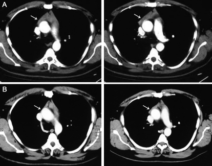 Ct-scan Images Showing A Thymus Enlargement Before (a) 