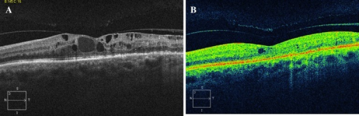 Baseline OCT scan (a) of patient with persistent DME in | Open-i