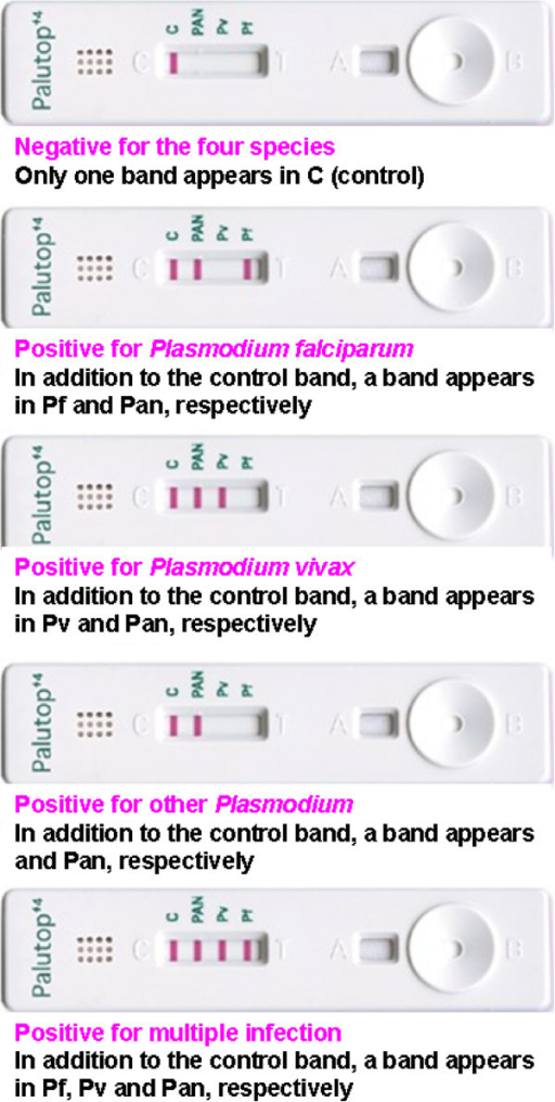 Malaria Diagnosis By Either The Palutop+4® Rapid Diagn | Open-i