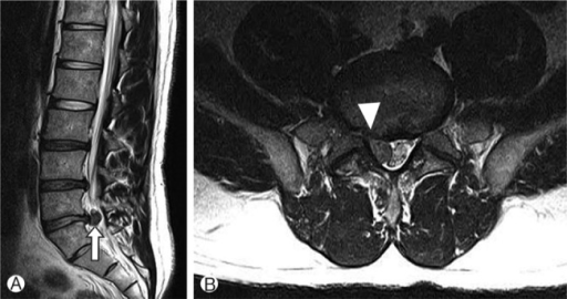 Sagittal (A) and axial (B) T2-weighted MR images of her | Open-i