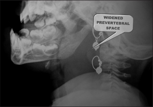 Widened Prevertebral Soft Tissue Shadow In X Ray Neck L Open I