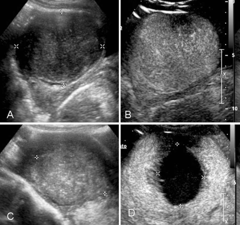 A 41 year old woman affected by a 7 cm symptomatic uter Open i