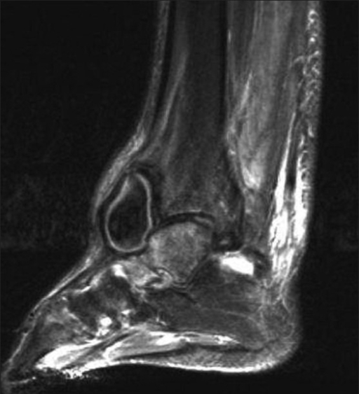 Sagittal MRI of the right ankle confirming the diagnosi | Open-i