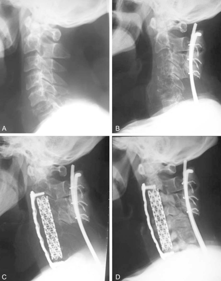 Case 1. Plain radiographs of the cervical spine (A) Pri | Open-i