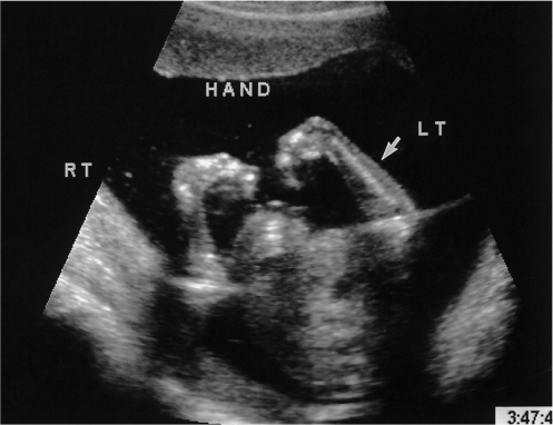 Radial ray abnormality.Second-trimester ultrasound reve | Open-i