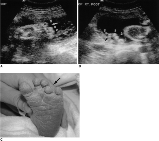 The ultrasound detection of chromosomal anomalies
