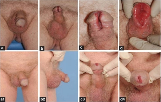 A small red spot on the penis