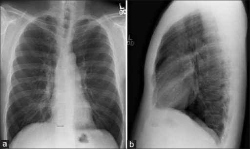 (a and b) Chest X-ray postero-anterior (PA) and lateral | Open-i