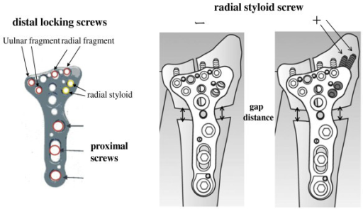 results of volar locking plate osteosynthesis for distal radial fractures results of volar locking plate osteosynthesis for distal radial fractures