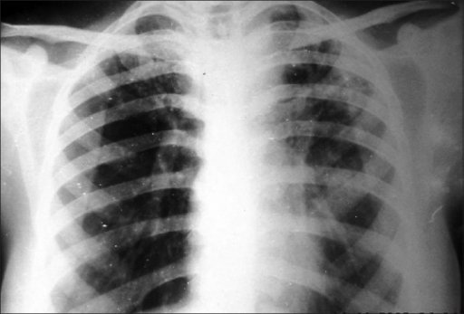 chest-x-ray-shows-bronchovascular-markings-are-accentuated-with-left