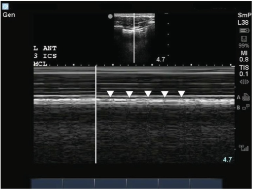 Lung Pulse Ultrasound