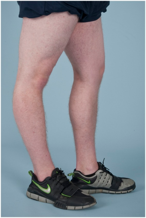 knee-hyperextension-genu-recurvatum-in-a-male-patient-open-i