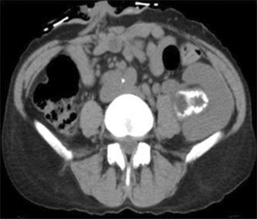 Abdominopelvic computed tomography revealed hydronephro | Open-i