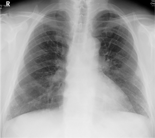 Chest X-ray film showing bilateral GGO in both lower lu | Open-i