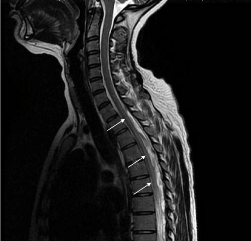 sagittal-t2-weighted-mri-scan-showing-the-dorsal-spinal-open-i