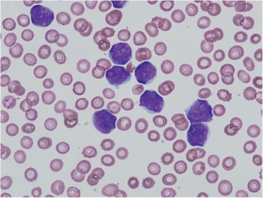 The peripheral blood smear shows an increased number of | Open-i