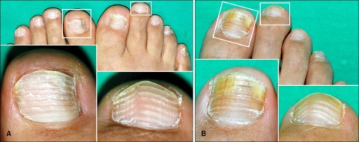 a-both-toenails-also-showed-multiple-transverse-bands-open-i