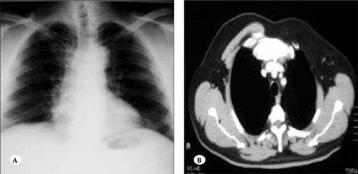 Clinical picture (A) Asymmetric chest with hypoplastic and