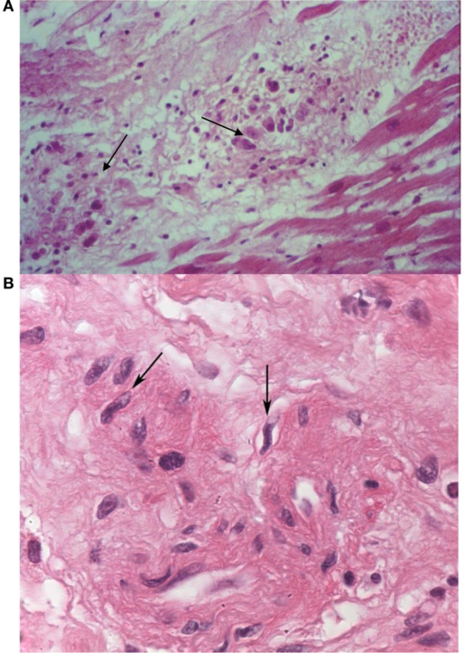 Histopathological findings – Aschoff nodules (arrows) | Open-i