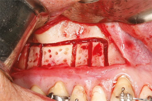 Corticomia dental