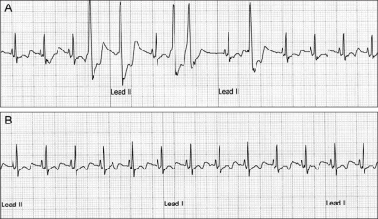 Electrocardiograms (ECG) from Case No. 2. (A) The ECG r | Open-i