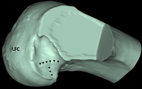 Three-dimensionally reconstructed CT-scan of the right | Open-i