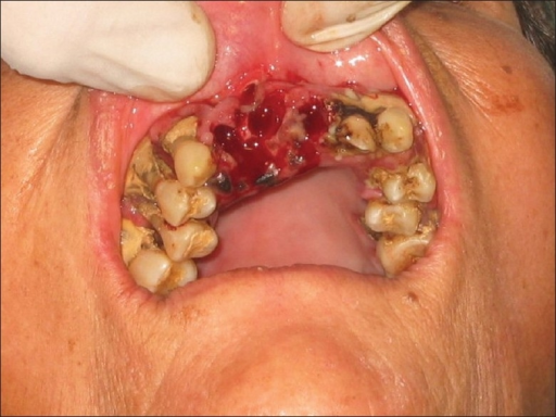 After extraction of involved mobile teeth