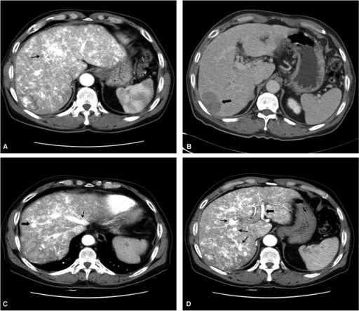 Dynamic liver CT images of hereditary hemorrhagic telan | Open-i