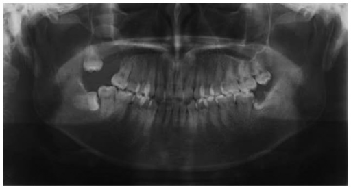 Maxillary Sinus Cyst Panoramic 7158