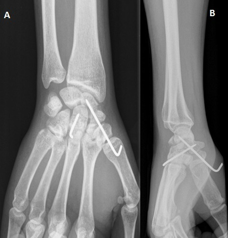 Radiographie du poignet droit de face et de profil: embrochage scapho-capital (A,B)
