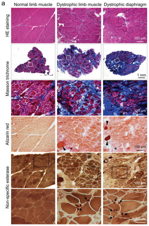 Characterization of muscle histopathology in carrier an | Open-i