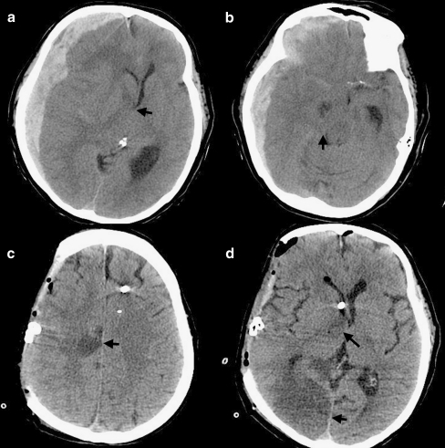 Infarction as complication of cerebral herniation. Larg | Open-i