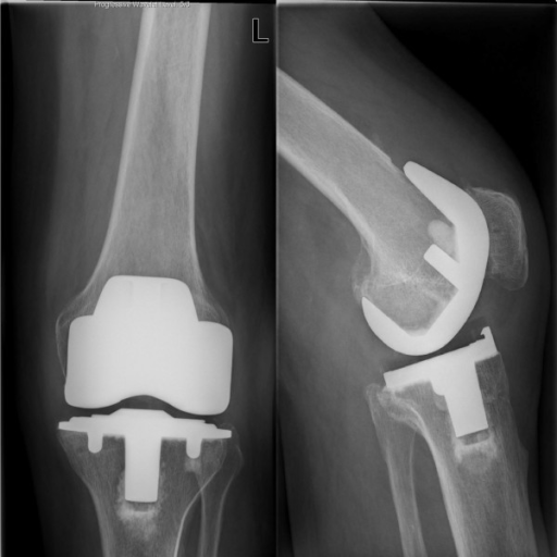 Radiographs of the prosthesis three years after total k | Open-i