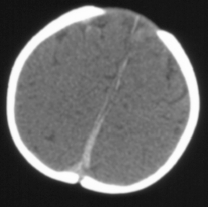 Computed tomography shows a subdural hematoma along the | Open-i