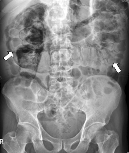 Plain film of abdomen shows diffuse linear intramural a | Open-i