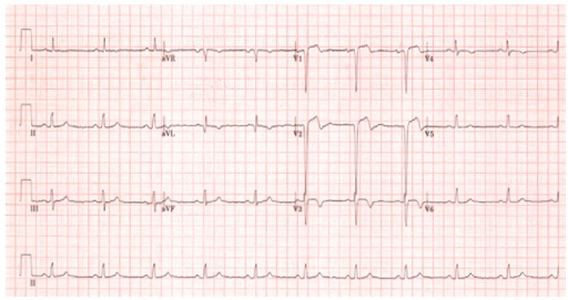 ECG. The ECG on admission showed a Q wave in V1 and V2 | Open-i