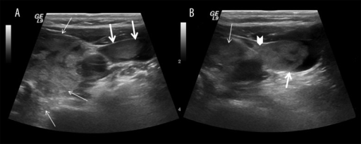 Ultrasonographic (US) examination of neck, the solitary | Open-i