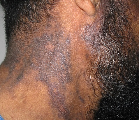 Dark brownish macules and papules of the neck | Open-i