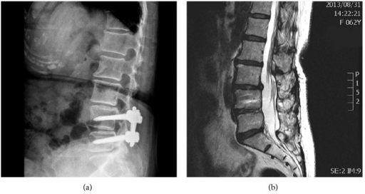 An illustrative patient who received open lumbar surger | Open-i