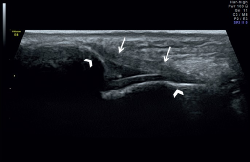 Anterior Cruciate Ligament Ultrasound