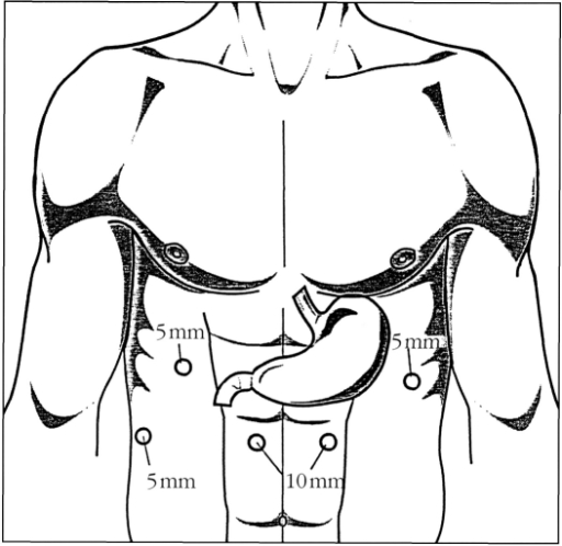 Abdominal trocar position for laparoscopic transhiatal | Open-i