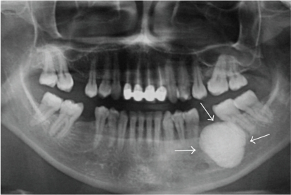 Panoramic radiograph showing a solitary, round, 3 × 3 | Open-i