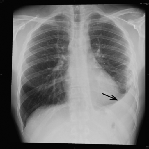 Chest X-ray showing left basal pneumonia with para-pneu | Open-i