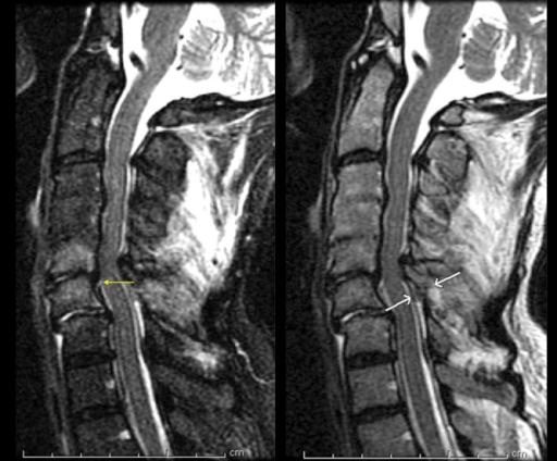 Ligamentum Flavum And Facet Hypertrophy 3592