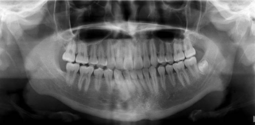 Panoramic radiograph shows well-defined multilocular ra | Open-i